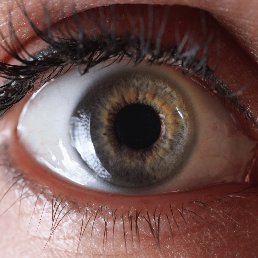 Retinal Detachment Symptoms | Associated Retina Consultants | Phoenix ...