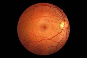 How Long Does it Take to Recover from a Retinal Tear? featured image