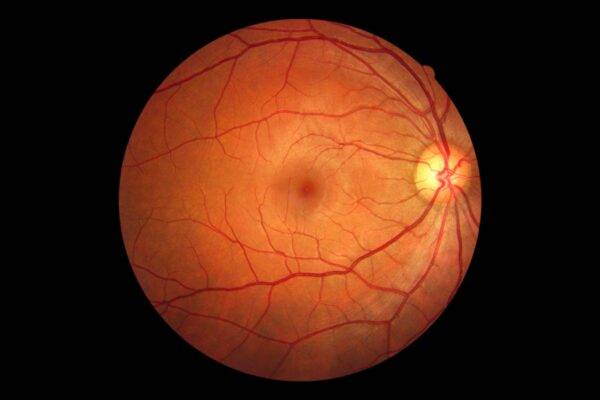 How Long Does it Take to Recover from a Retinal Tear? featured image