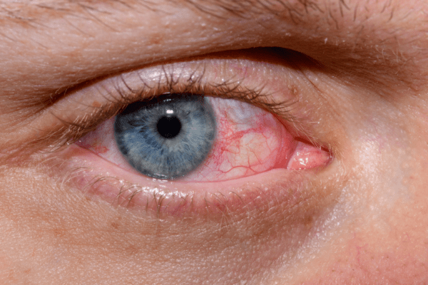 Can Dry Eyes Cause Retina Problems? featured image