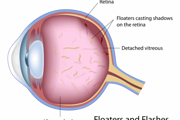 Understanding the Retina: What Causes Floaters and How a Vitrectomy Can Help featured image