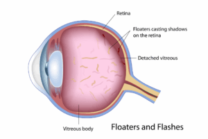 Understanding the Retina: What Causes Floaters and How a Vitrectomy Can Help featured image