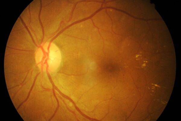 Can Exercise Improve Blood Flow to the Retina? What the Research Shows featured image