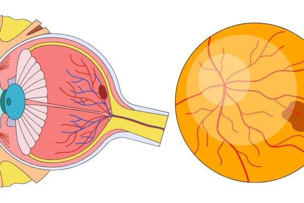What Is an Epiretinal Membrane? featured image